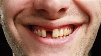 دواء جديد قد يُحدث ثورة في طب الأسنان.. وتجارب بشرية لإعادة إنماء الأسنان المفقودة
