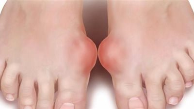 تعرف على العلاجات البديلة للوقاية من النقرس