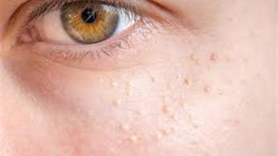 ما هى حبوب الميليا؟.. تعرف على أبرز 10 علاجات منزلية مفيدة للتخلص منها