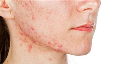أسباب غير متوقعة تؤدي إلى ظهور حب الشباب.. تعرف عليها