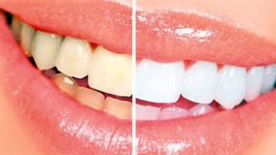 5 طرق لمنع اصفرار الأسنان