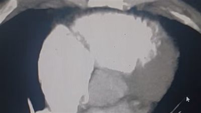 مريضة تعود للحياة بعد توقف قلبها 5 مرات في مستشفى أشمون العام بسبب جلطة رئوية ضخمة