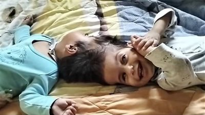 بعد فشل العملية الخامسة.. وفاة توأمين ملتصقين على طاولة العمليات بالبرازيل 