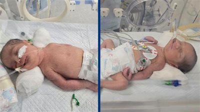 العملية استغرقت 10 دقائق.. الصحة تكشف تفاصيل جديدة في ولادة توأم بعد وفاة والدتهما