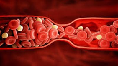 تعرف على أسباب وأعراض سرعة ترسب الدم