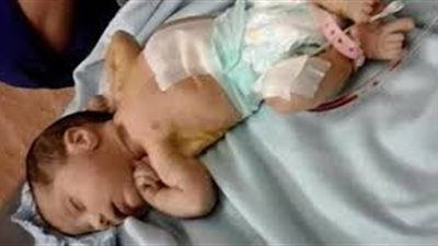 تفاصيل استخراج جنين من بطن رضيعة عمرها أسبوع بأسيوط