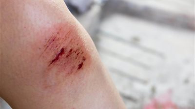 دراسة تكشف أهم أسباب عدم التئام الجروح بسرعة