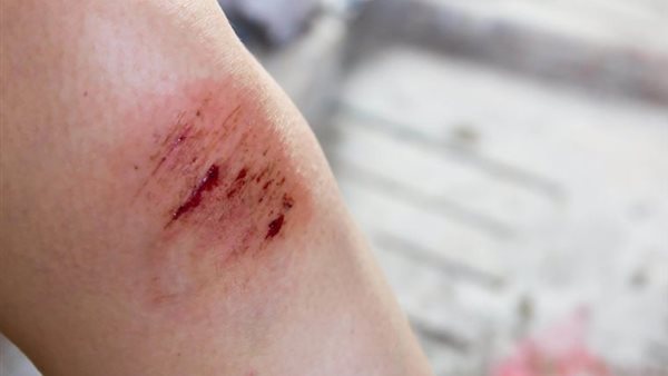 الجروح - أرشيفية