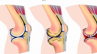 تعرف على أسباب خشونة الركبة وطرق الوقاية منها