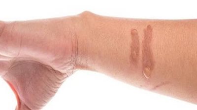 أنواع الحروق.. وكيفية علاجها بجميع درجاتها