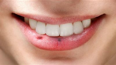 ما الحقيقة وراء عدوى سرطان الفم؟