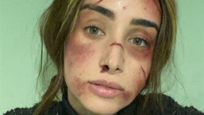 بجروح وكدمات في الوجه.. هنا الزاهد: 