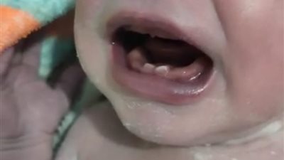 سوهاج تشهد معجزة في حالة ولادة نادرة لم تتكرر (صور)