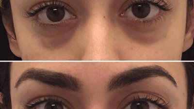 لعلاج الهالات السوداء والجلد الميت.. 20 نصيحة  للتخلص من كل مشاكل البشرة