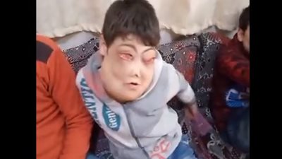 مجلس الوزراء يستجيب لذوي طفلين يعانيان من مرض نادر بالوجه