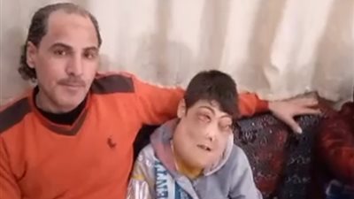 والد الطفلين مريضَي الورم بالوجه: 