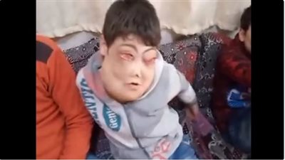 مجلس الوزراء يستجيب لذوي طفلين يعانيان من مرض نادر بالوجه