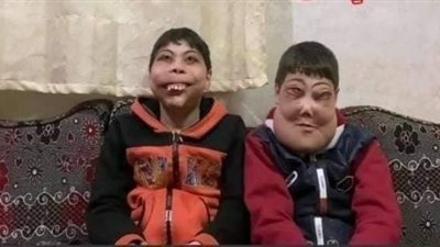 الصحة تستجيب لوالد الطفلين ضحايا التنمر بسبب إصابتهما بمرض نادر في الوجه (فيديو)