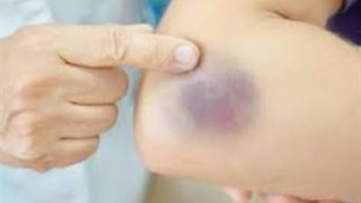 طرق منزلية لعلاج  الكدمات في المنزل.. تعرف عليها