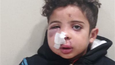 تفاصيل واقعة عقر كلب لطفل بمدينة بورفؤاد (صور)  