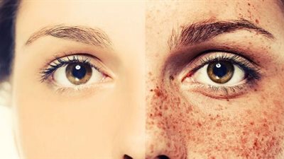 أخطاء شائعة تسبب فرط التصبغ.. تعرفي عليها