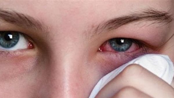 التصاق الجفون والقشعريرة تعرف على أعراض مرض رمد العين