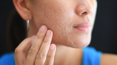 تعرف على أسباب قشور الوجه وعلاجه