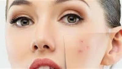 الوقاية من الشمس واختيار الغسول المناسب.. تعرفي على كيفية التخلص من حبوب الوجه بسرعة