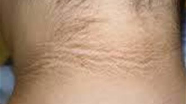 العلامة السوداء