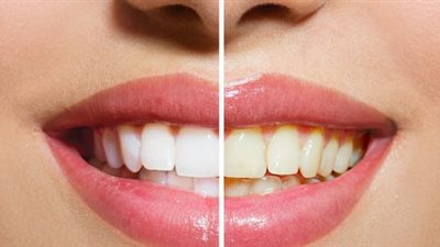 حيل طبيعية للتخلص من اصفرار الأسنان