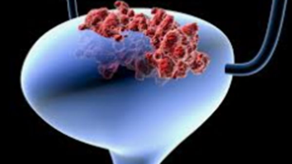 سرطان المثانة