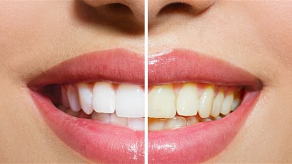 اصفرار الأسنان