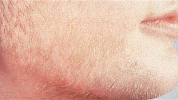 أعراض زيادة هرمون