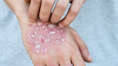 تعرّف على طرق العلاج المنزلية لمقاومة مرض الصدفية