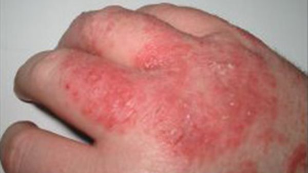 إكزيما الجلد