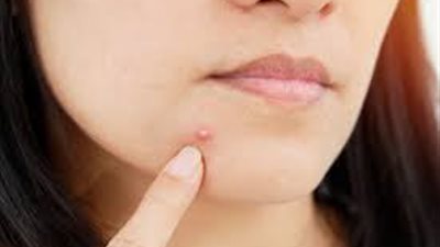 5 نصائح للتعامل مع حب الشباب لدى البالغين