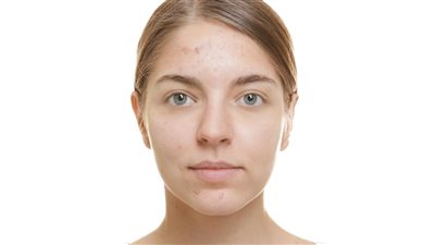 مرض معدٍ يظهر في منطقة الصدر والظهر.. طرق اكتشاف حب الشباب الفطري