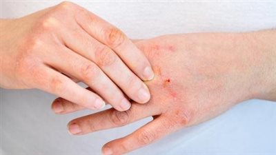 منها زيارة المستشفى باستمرار..  تعرف على أسباب الإصابة بالفطريات الجلدية وعلاجها