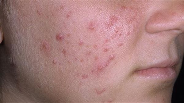 مشكلة حب الشباب لدى