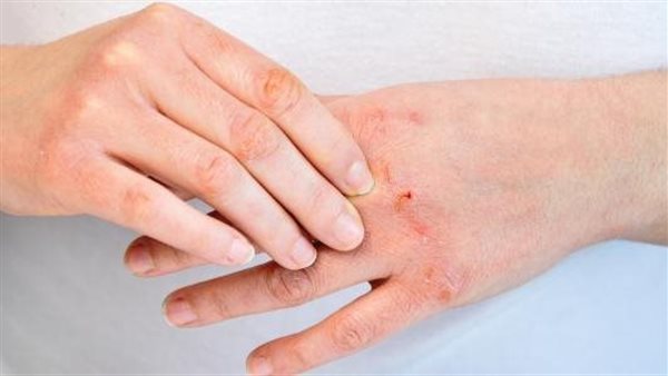 التهاب الجلد- أرشيفية