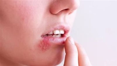 ما هو فيروس إبشتاين بار وكيف يمكن الوقاية منه؟