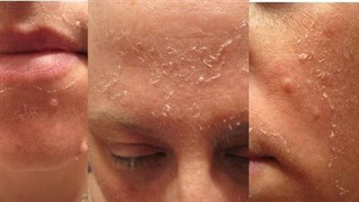 تعرف على أبرز فوائد و أضرار التقشير الكيميائي