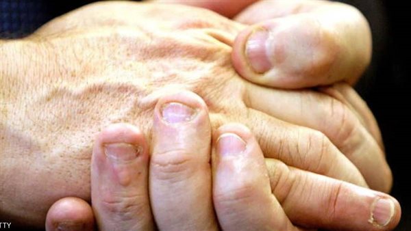 نقص الفيتامينات