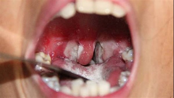 مرض الدفتيريا