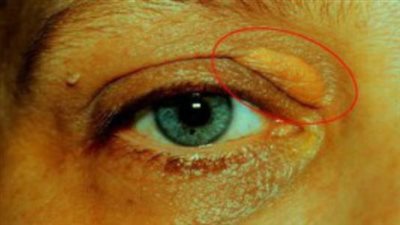 زيادة الوزن وارتفاع ضغط الدم.. تعرف على أسباب ظهور اللويحة الصفراء 