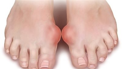 تعرّف على سبب تسمية مرض داء الملوك بهذا الاسم