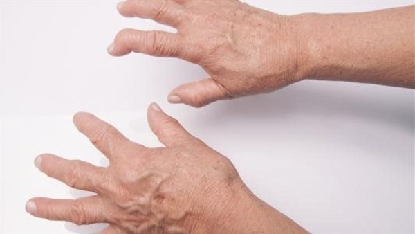 مرض الروماتيزم (أرشيفية)