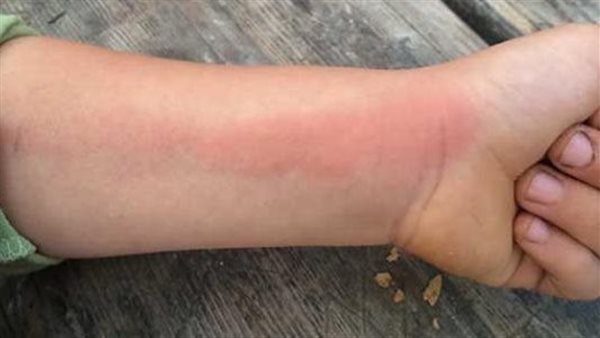 تسمم غذائي أرشيفية