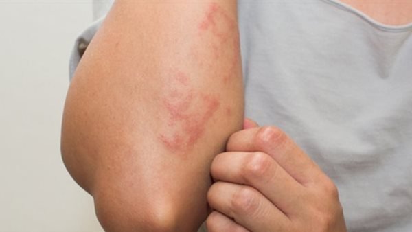  أنواع الحساسيات