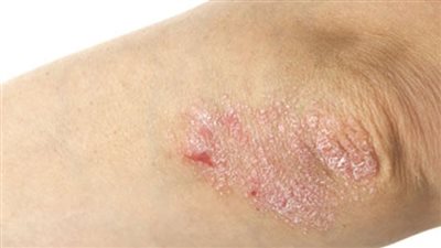 أخصائية طب طبيعي: خشونة مفاصل اليدين مرض شائع أكثر من الظهر والركبة